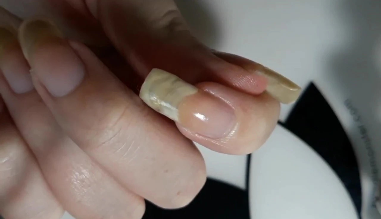 Broken nail repair, September 2018