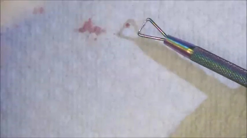 Cleaning up excess gel remover with a paper towel.