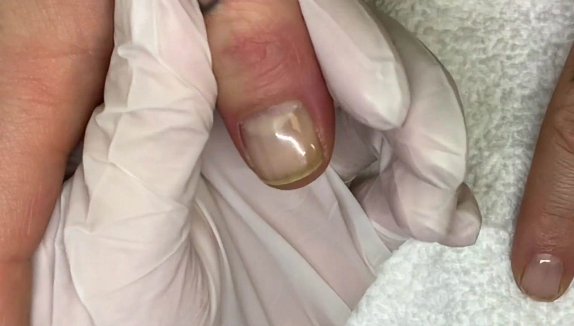 Close-up showing yellowing on one thumb.
