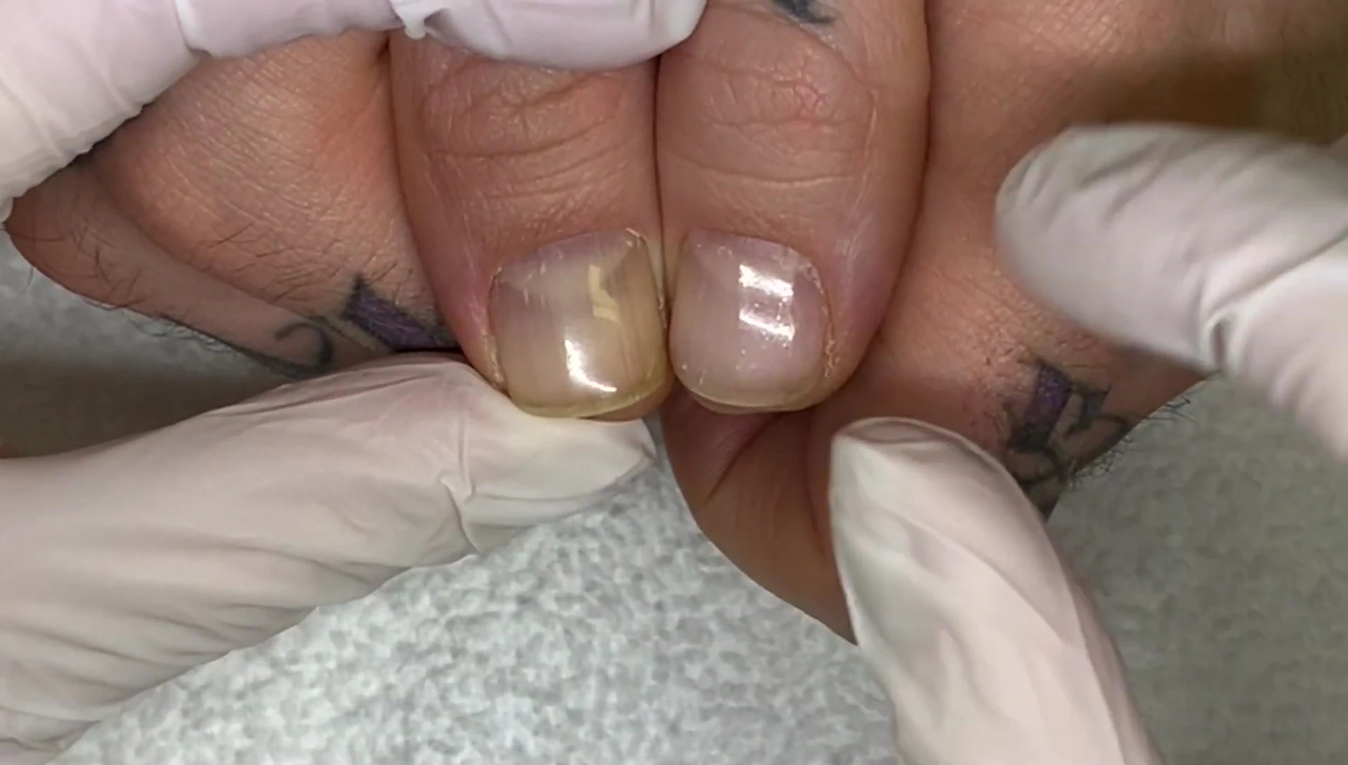 Comparison of the two hands showing a difference in texture