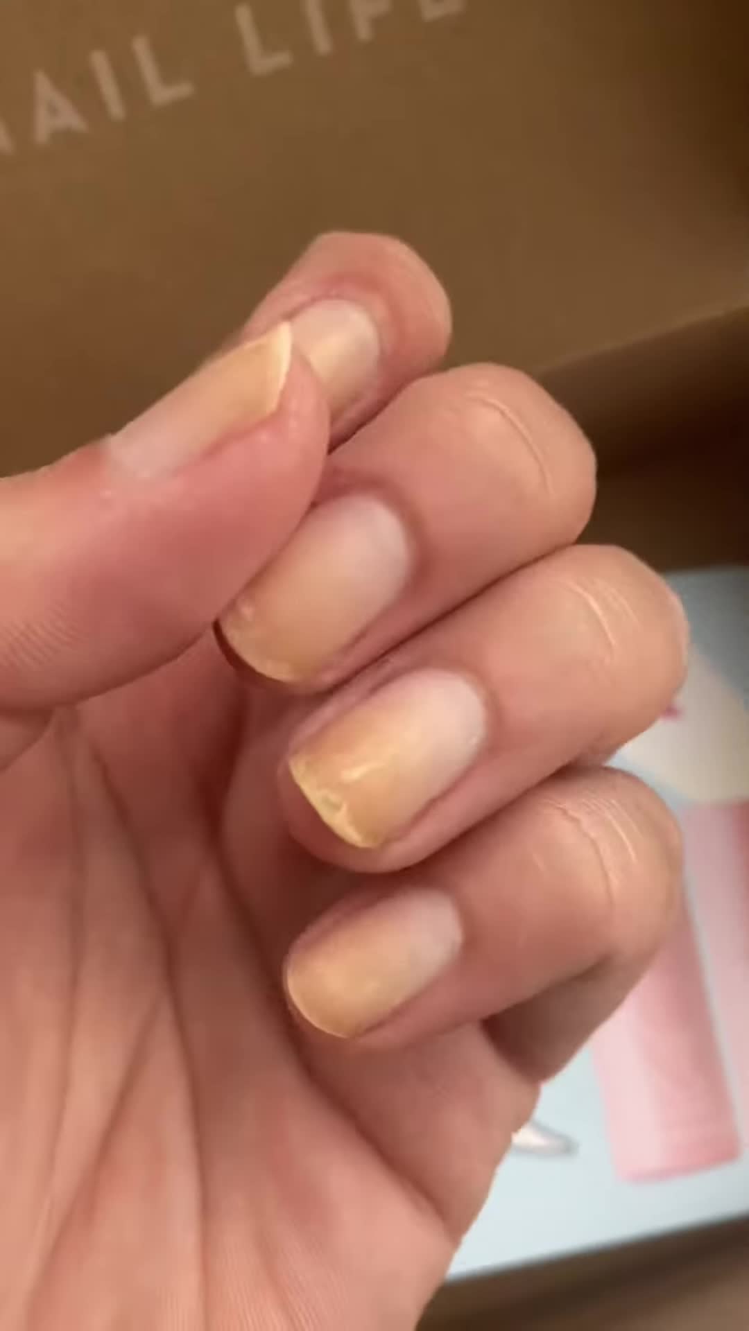 Close-up of dry, brittle nails showing ridges and peeling