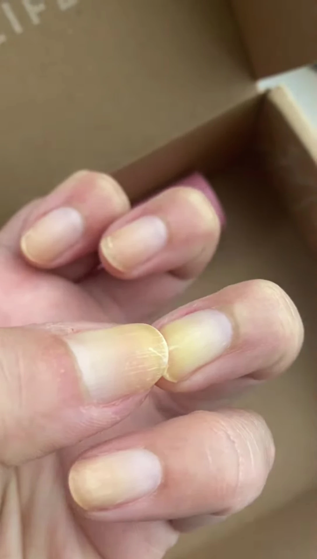Close-up showcasing peeling on the nail